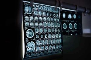 Rehabilitacja neurologiczna